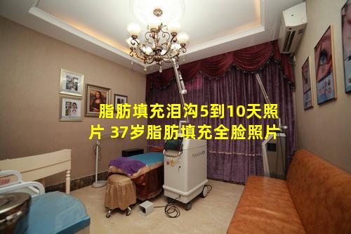 脂肪填充泪沟5到10天照片 37岁脂肪填充全脸照片